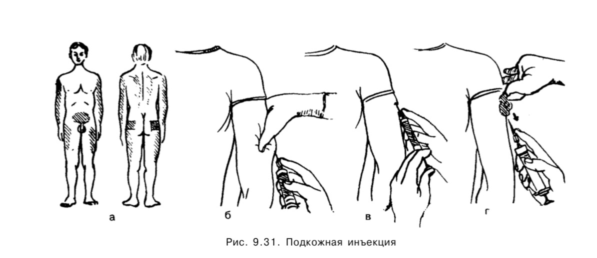 Алгоритм подкожной инъекции. Подкожная инъекция в плечо. Техника внутримышечной инъекции в дельтовидную мышцу. Подкожная инъекция в плечо алгоритм. Место постановки внутримышечной инъекции в плечо.