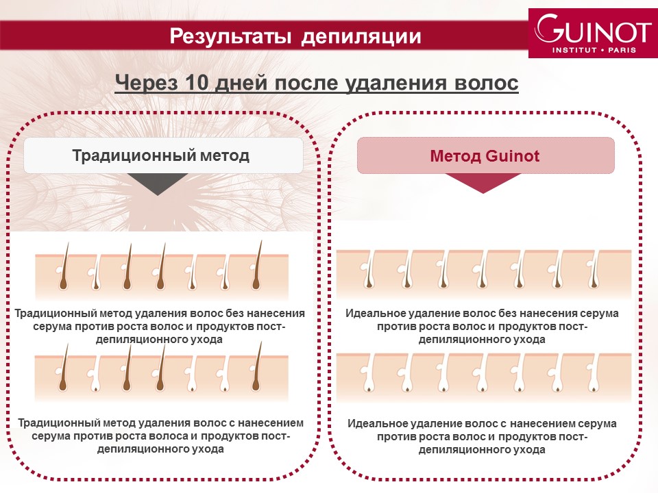 Какой вид депиляции. Зоны эпиляции. Плакаты по депиляции. Плакат лазерная эпиляция. Плакаты для мастера лазерной эпиляции.