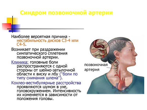 Сосудистый шум в голове. Головокружение и рвота при шейном остеохондрозе. Шейный остеохондроз и головокружение. Головокружение при остеохондрозе шейного отдела позвоночника. При шейном остеохондрозе кружится голова.