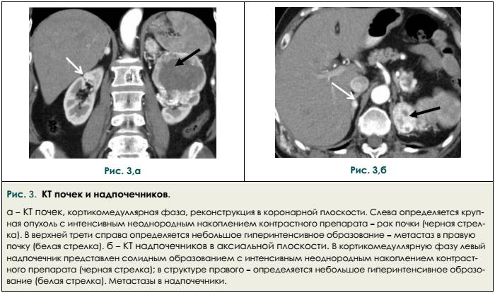 Кт картина образования правой почки