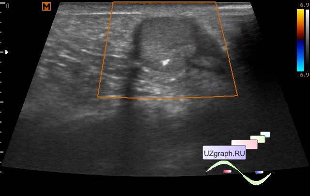 Микролиты в почках что. Микролиты на УЗИ. Микролиты почек по УЗИ. Целомическая киста перикарда на УЗИ.