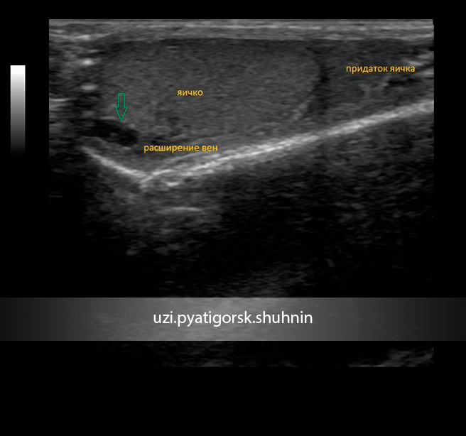 Увеличивается левое яичко. Сонограмма варикоцеле. Варикоцеле УЗИ картина.