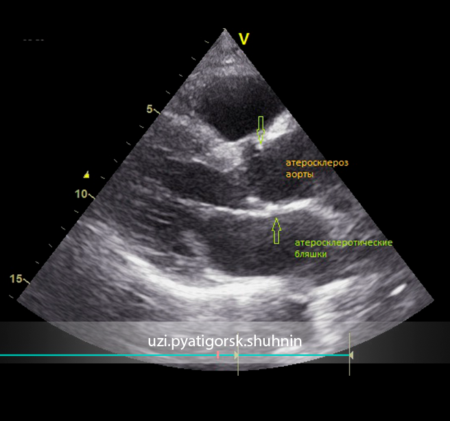 Аневризма брюшной аорты УЗИ. Атеросклероз аорты на ЭХОКГ. Аневризма коронарного синуса ЭХОКГ. Атеросклероз брюшного отдела аорты.