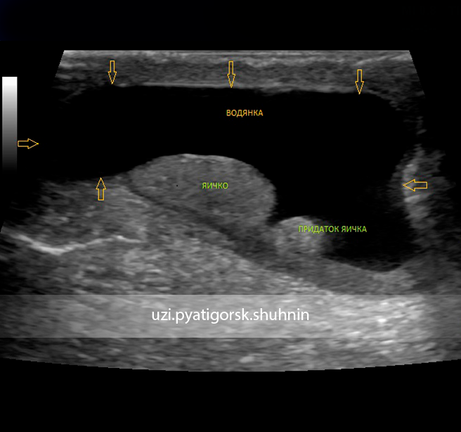 Лечение водянка яичка у мужчин без операции. Водянка оболочек яичка УЗИ. Водянка яичка УЗИ заключение. Водянка оболочек яичек новорожденного.