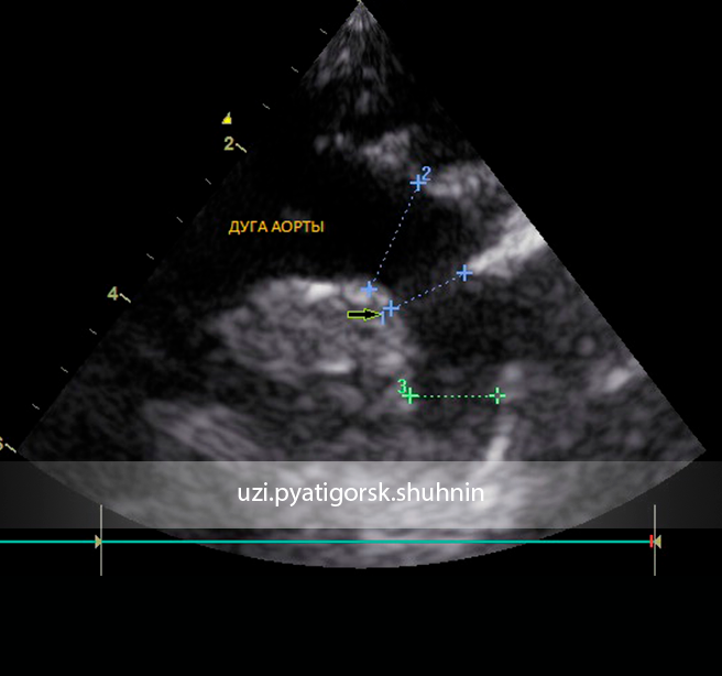 Узи аорты. Коарктация аорты эхокардиография. На ЭХОКГ двойная дуга аорты. Коарктация аорты у детей на УЗИ.