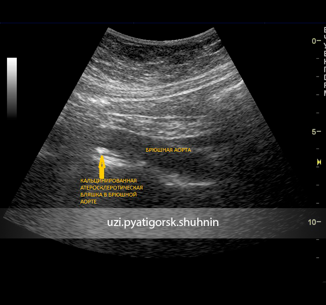 Узи брюшной аорты