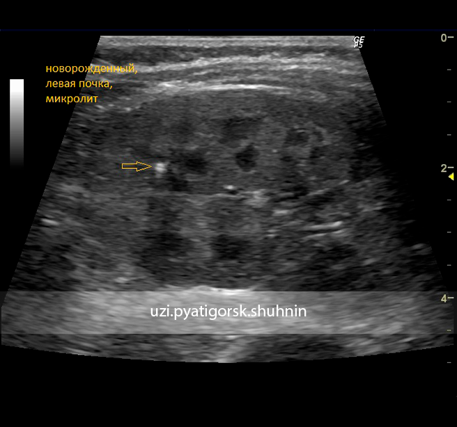 Микролиты в почках. Микролиты в почках на УЗИ. Микролитиаз почек УЗИ. Множественные микролиты в почках 2,1 мм на УЗИ. Микролит левой почки УЗИ.