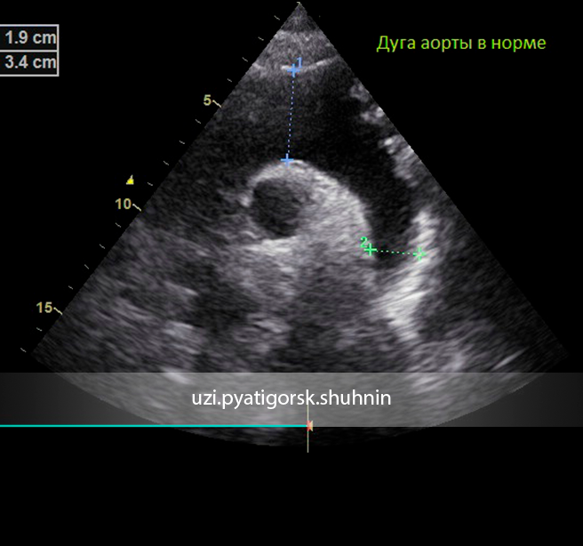 Сделать узи аорты. Коарктация аорты эхокардиография. Норма дуги аорты эхокардиография.