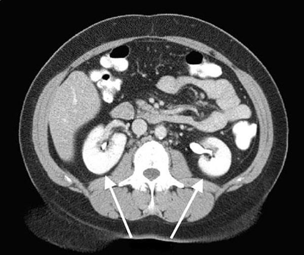 Кт с контрастом почек. Кт при мочекаменной болезни. Кт брюшной полости надпочечники с контрастом.