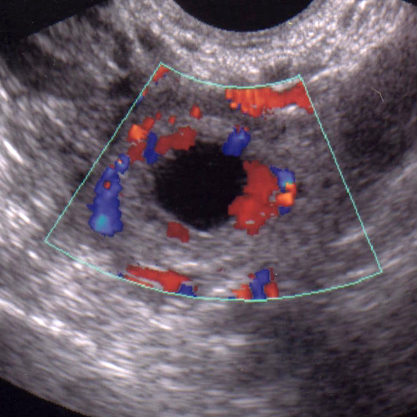 Внематочная беременность узи фото