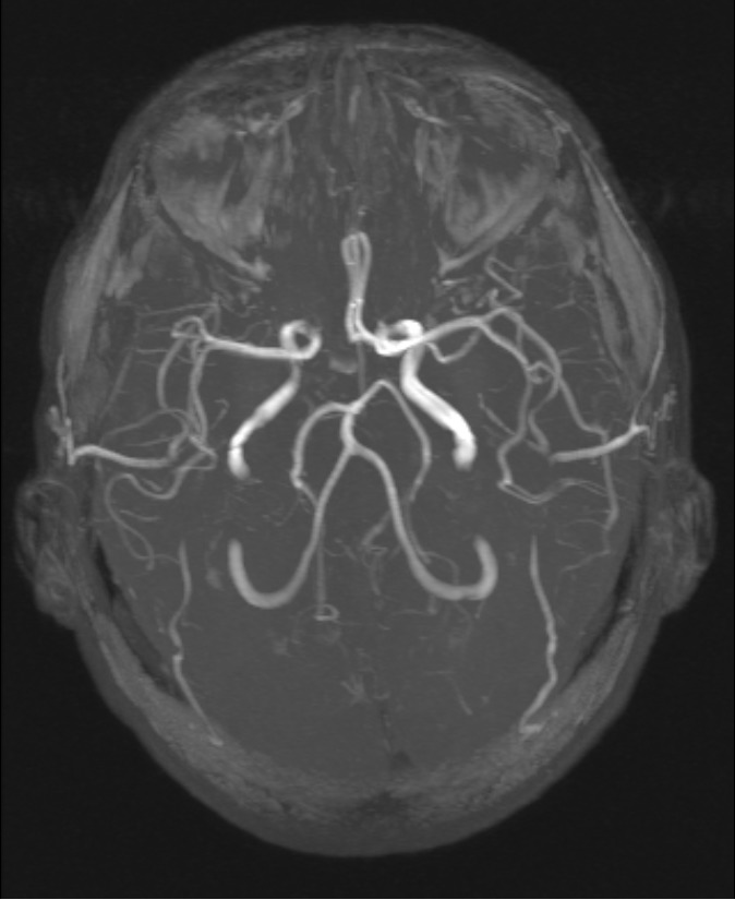 Аневризма головного мозга. Аневризма головного мозга MRT. Аневризма головного мозга мрт. Аневризма головного мозга снимки. Снимок мрт головного мозга с аневризмой.