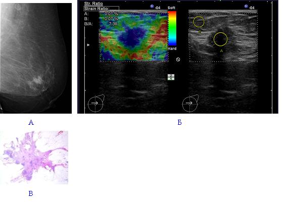 Какое узи молочных желез лучше делать. Эластография молочной железы фиброаденома. УЗИ молочной железы допплер. УЗИ молочных желёз с эластографией. Фиброаденома бирадс УЗИ.