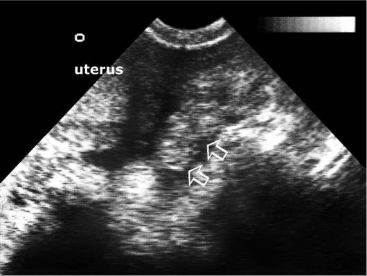 Внематочная Беременность Фото Узи