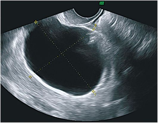 Функциональная киста яичника на узи фото