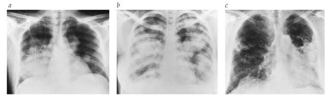 (a) Bacteremic pneumococcal pneumonia caused the extensive bilateral multifocal infiltrates revealed in this chest radiograph of a 27-year-old man. (b) Alveolar sarcoidosis is the cause of the extensive bilateral multifocal infiltrates shown in this chest radiograph. The patient is a 22-year-old woman. (c) Alveolar cell carcinoma often presents as multifocal infiltrates, as seen in this chest radiograph of a 65-year-old man.