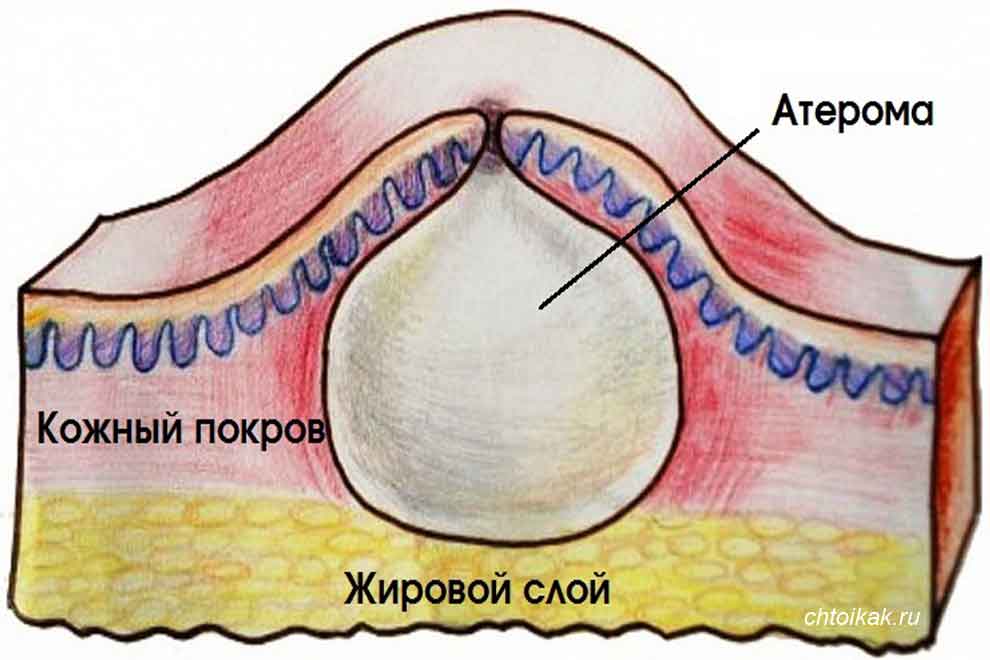 Личинки жировика геншин