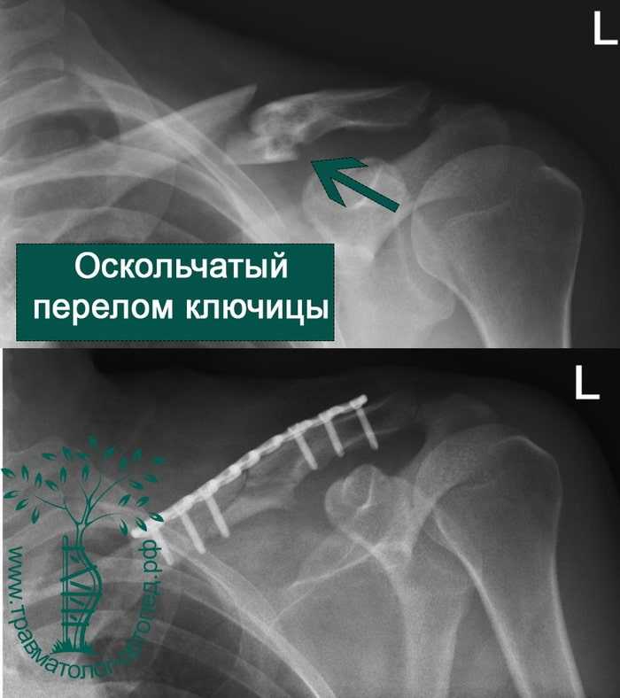 Перелом ключицы. Винтообразный перелом ключицы.