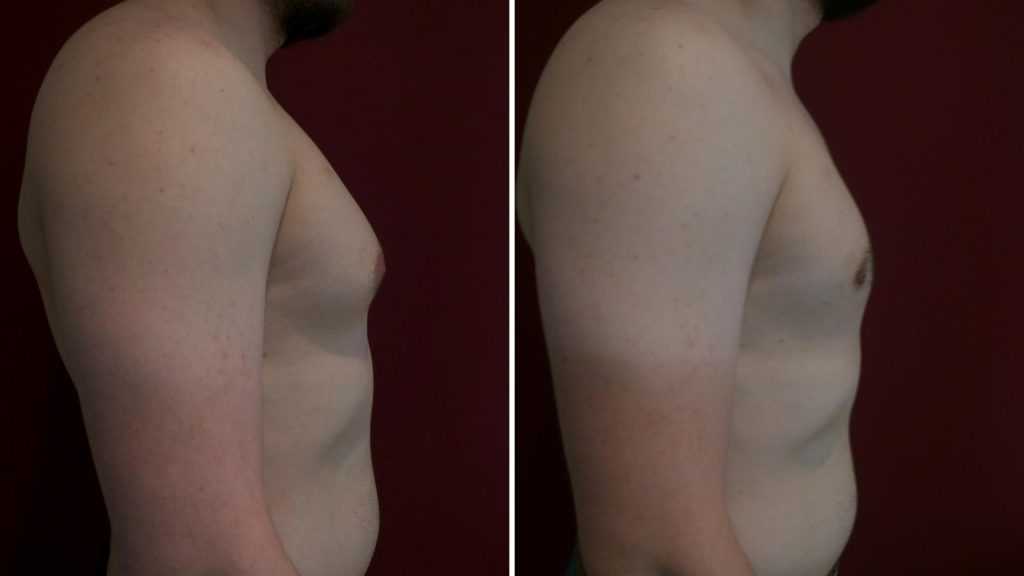 Операция по уменьшению груди фото до и после