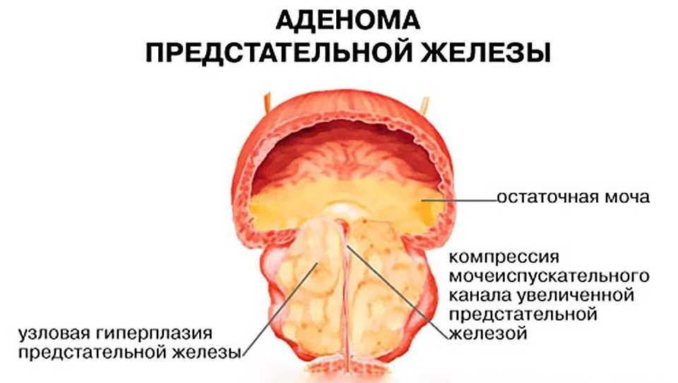 Гиперплазия предстательной железы фото