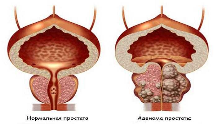 Хроническая простата аденома
