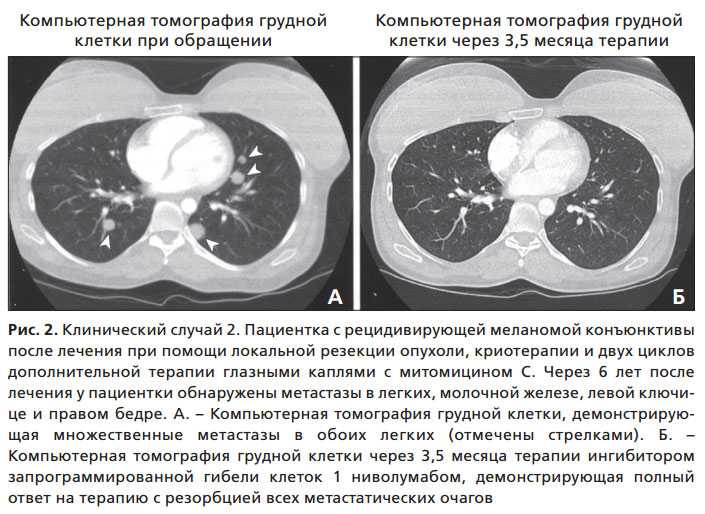 Можно по кт определить. Компьютерная томография грудной клетки норма. Кт грудной клетки норма. Кт грудной клетки результат. Компьютерная томография (кт) легких.