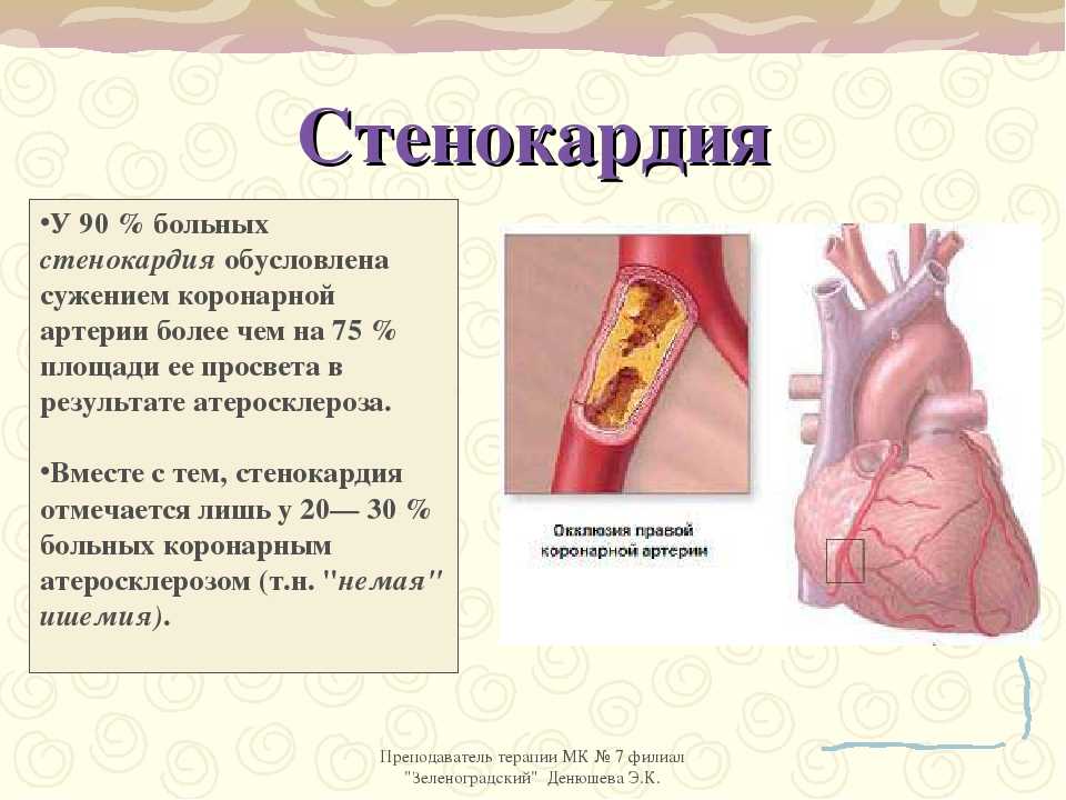 Больному стенокардией. Ишемическая болезнь сердца симптомы профилактика. Стенокардия презентация. ИБС стенокардия презентация.