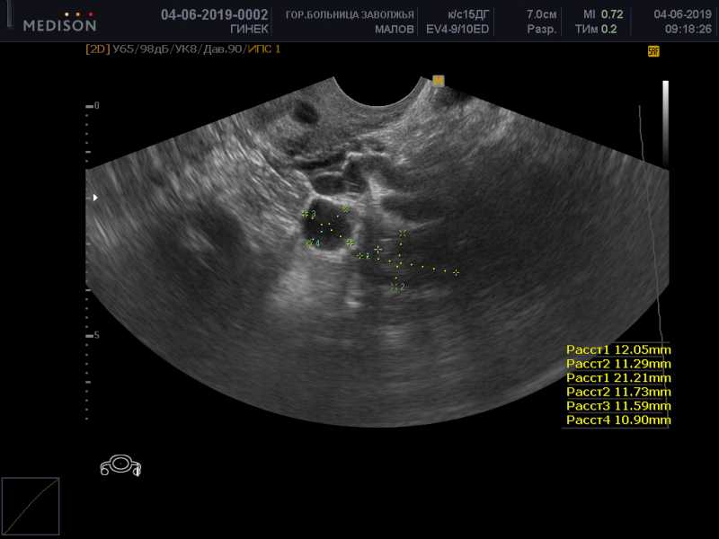 Киста яичника orads. Киста яичника 8мм параовариальная. Параовариальная киста на УЗИ яичника. Параовариальная киста яичника клиника. Параовариальная киста яичника 10мм.