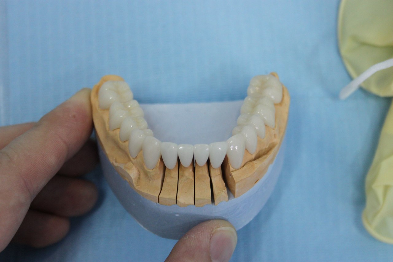 Зубы спб. Торус это ортопедическая стоматология. Съемный мостовидный протез. Металлокерамические протезы челюсти. Керамические съемные протезы.