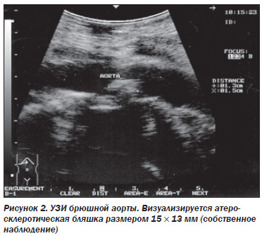 Узи аорты. УЗИ брюшной аорты заключение. Атеросклероз брюшной аорты на УЗИ. УЗИ брюшной аорты протокол. Атеросклероз брюшного отдела аорты УЗИ заключение.