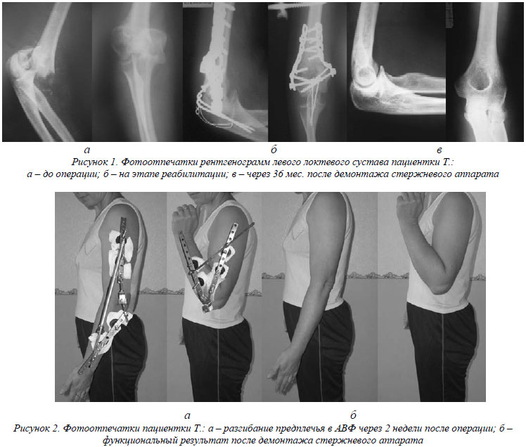Операция локтевого сустава реабилитация
