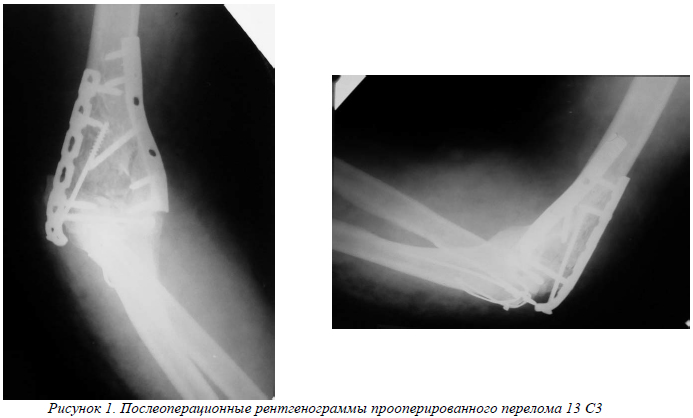 Перелом локтя. Внутрисуставной перелом локтевого сустава. Внутрисуставные переломы костей локтевого сустава. Межмыщелковый перелом локтевого сустава. Закрытый внутрисуставной перелом локтевой кости.