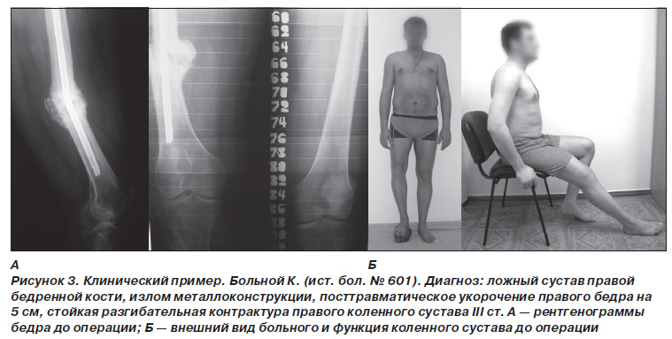 Контрактура сустава код