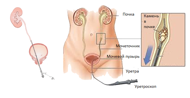 Стенд на мочеточнике фото