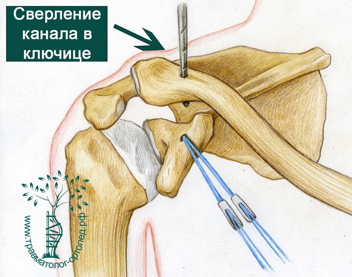 Вывих ключицы. Трансартикулярная фиксация ключицы спицами. Спицы при вывихе ключицы.