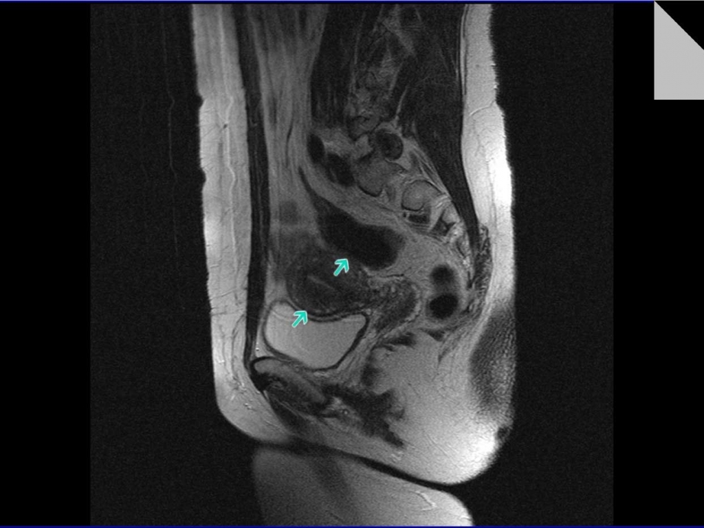 Мрт простаты. Мрт малого таза срезы сагиттальные. Мрт женского таза сагиттальное. Аденомиоз рентгенография.