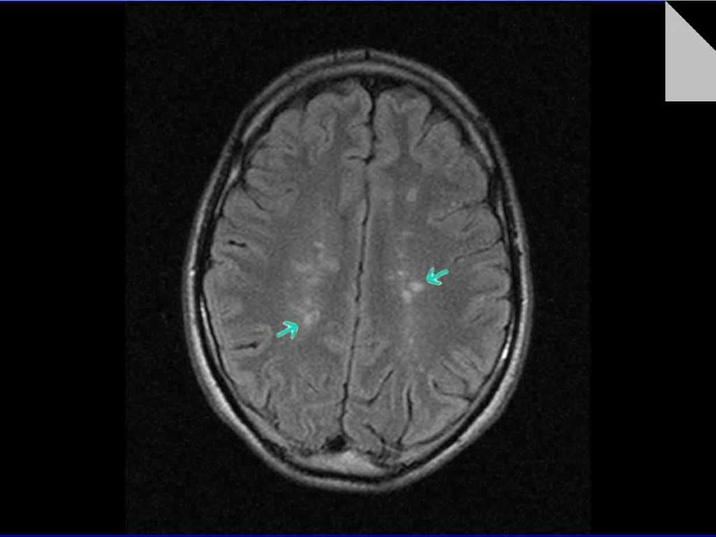 Мр картина единичных супратенториальных микроочагов глиоза