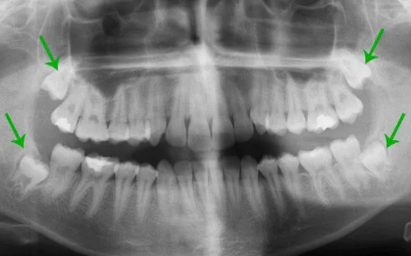 Ретенирование зуба. Дистопированный зуб мудрости рентген. Ретинированный 8 зуб рентген. Ретинированный зуб мудрости рентген.