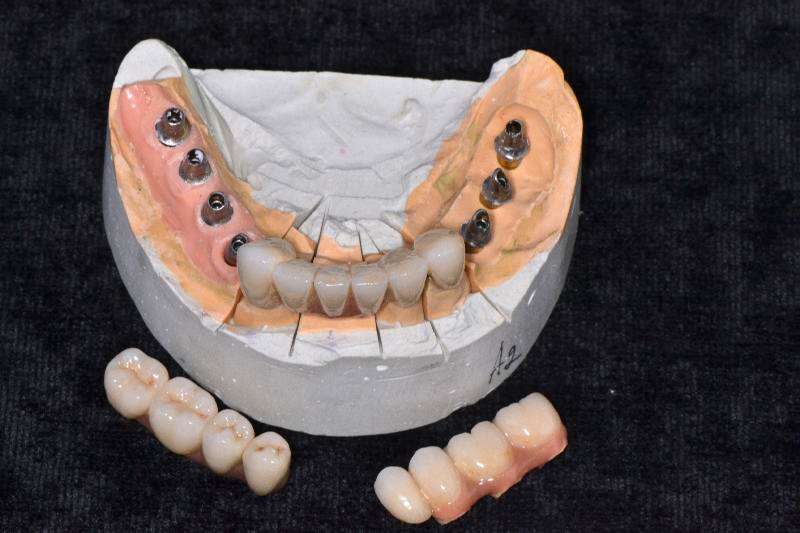 Мост на имплантах на 3. Мостовидный протез с опорой на имплантах. Мостовидный протез с опорой на импланты. Металлокерамический протез на имплантах.
