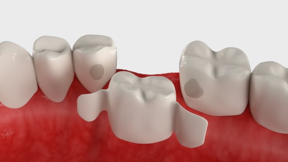 Адгезивный мостовидный протез что это такое фото