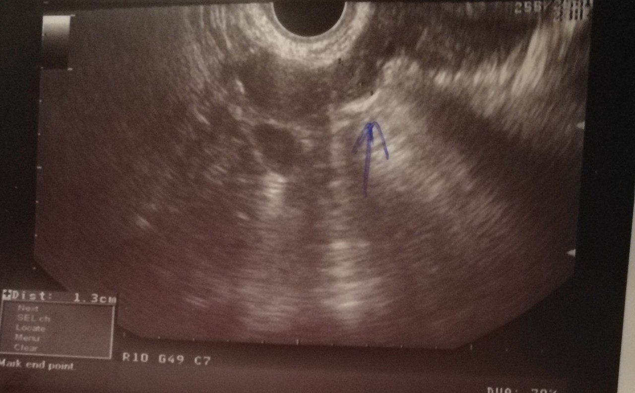 На узи видно внематочную. УЗИ внематочной беременности 5 недель. УЗИ 5 недель беременности внематочная беременность. 4 5 Недель беременности УЗИ внематочная. Внематочная беременность УЗИ 7 недель.