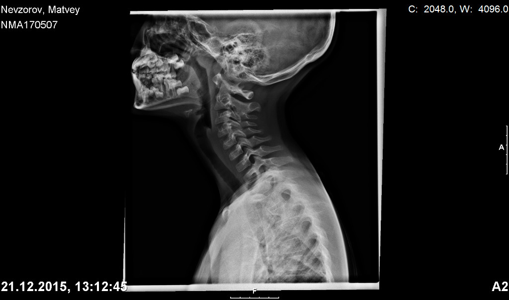 Рентген шейного позвоночника