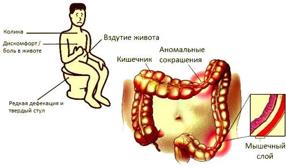 Каловые массы в кишечнике. Движение кала по кишечнику схема. Скопление каловых масс.