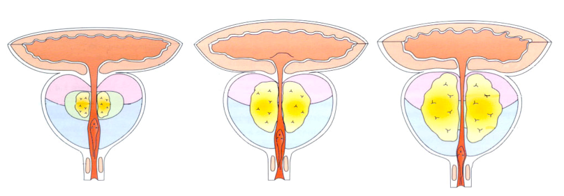 Аденома простаты 3 степени. ДГПЖ предстательной железы что это такое. Доброкачественная гиперплазия предстательной железы стадии. Доброкачественная гиперплазия предстательной железы в стадии 3а. Тело простаты