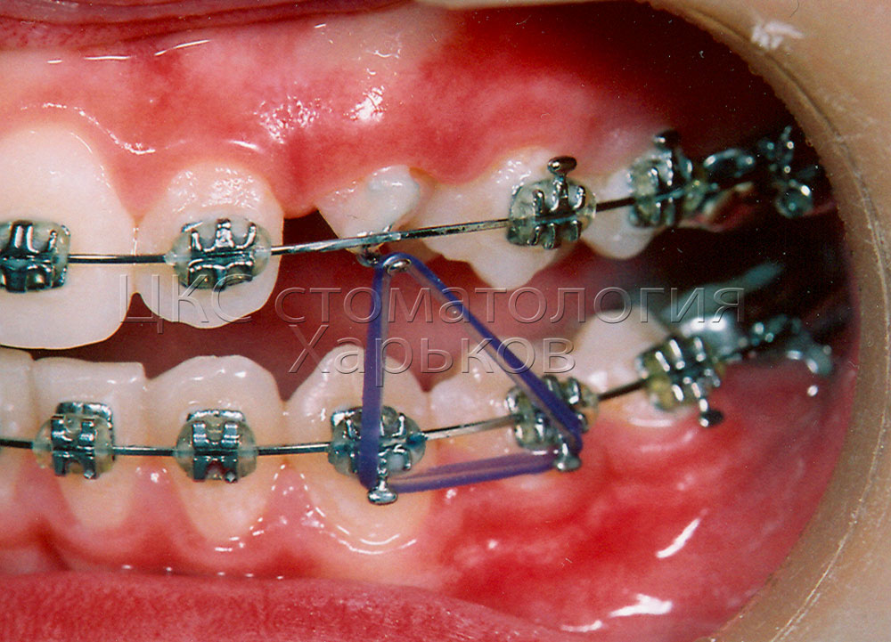 Тяги на брекеты фото