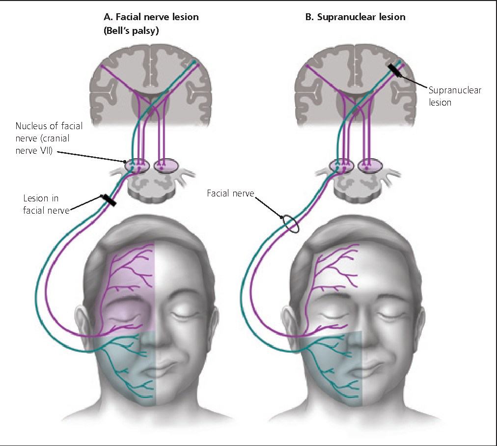 Центральный и периферический парез лицевого нерва