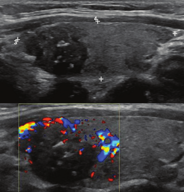 Рак щитовидной железы на узи фото как выглядит