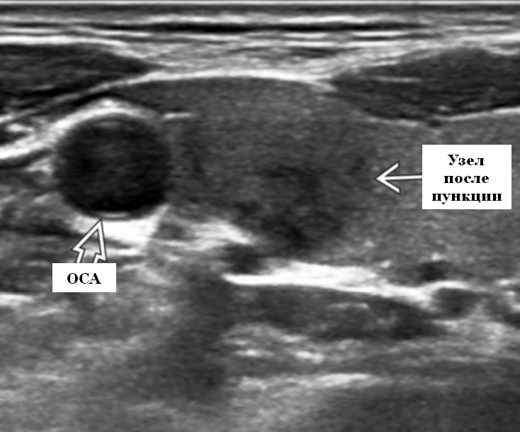 Узелок в щитовидной. Гипоэхогенные узлы на УЗИ щитовидной железы. УЗИ щитовидной железы гипоэхогенное образование. Кальцинат щитовидной железы УЗИ. Гипоэхогенное образование в молочной железе на УЗИ.
