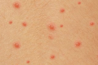 Small red spots, filled with fluid, on white skin.