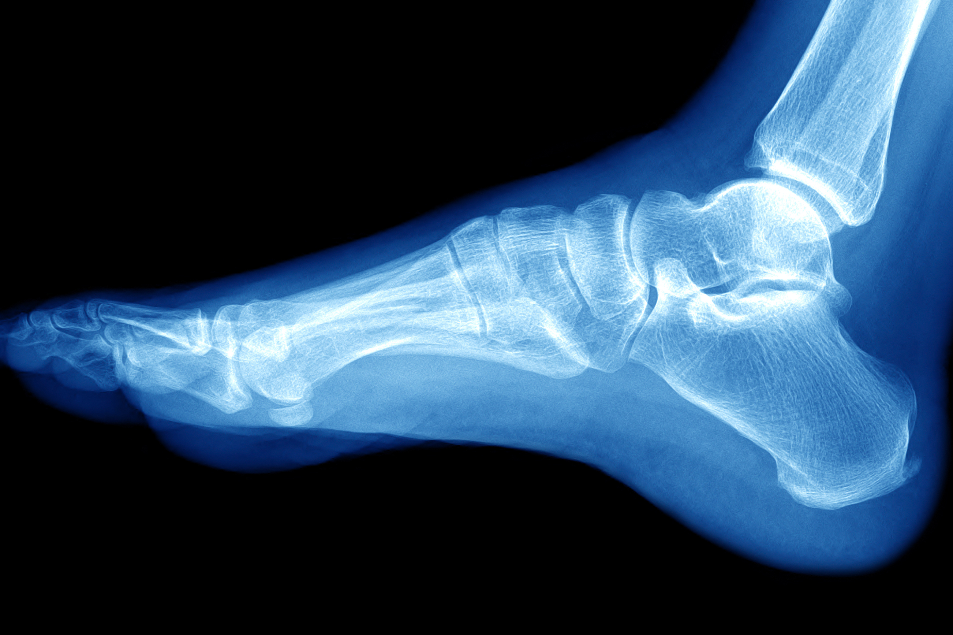 Голеностопный сустав левой ноги. Голеностопный сустав рентген норма. Голеностопный сустав рентген. Кости голеностопного сустава рентген. Голеностоп сустав рентген.