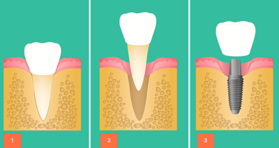 Имплант после удаления зуба. Одномоментная имплантация зубов этапы. Этапы одномоментной имплантации зуба. Одномоментная (одноэтапная) имплантация. Двухэтапная имплантация зубов этапы.